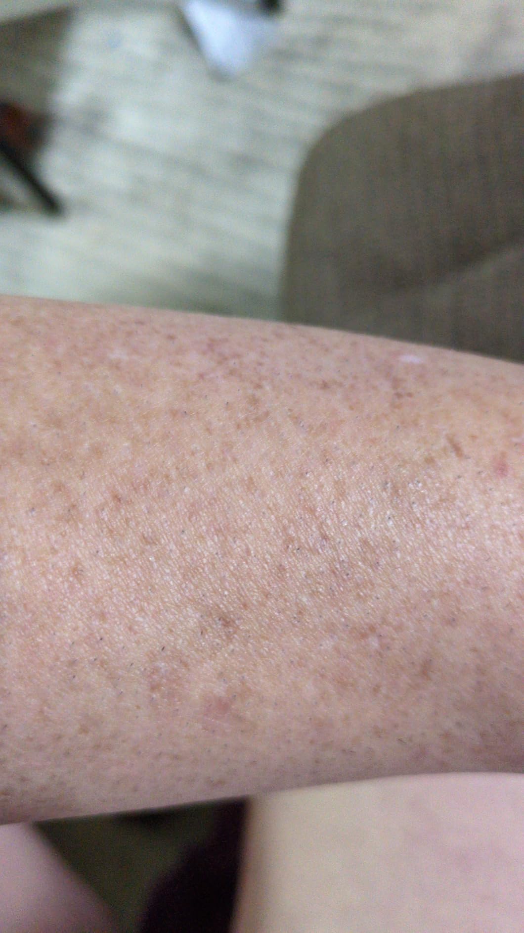 Nood Flasher Pro IPL Laser Hair Removal Device, Clinical-Grade Permanent Results At Home, CryoSoothe Tech with 5 Power Settings customer photo 1