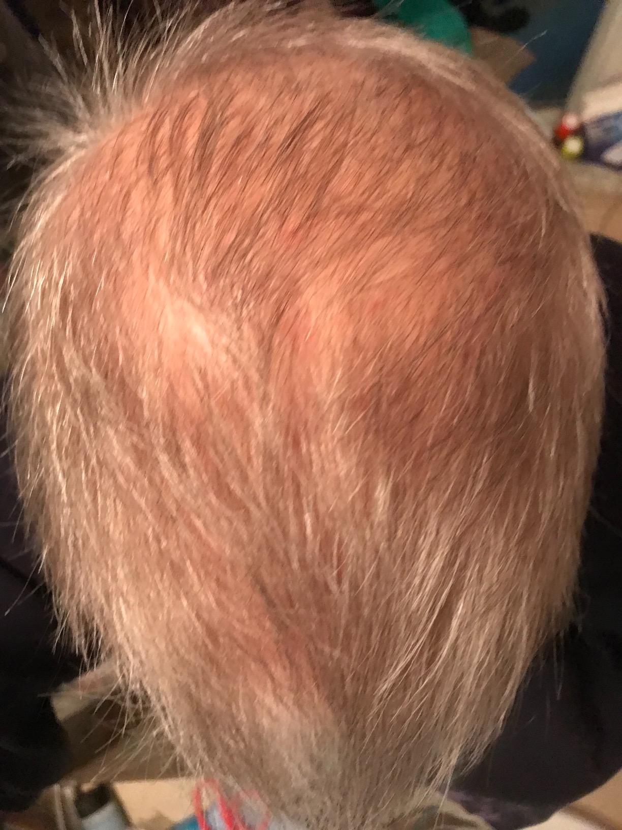 iRestore Essential - Laser Red Light Therapy for Hair Growth - FDA Cleared Hair Loss, Hair Thinning & Alopecia Treatment for Men & Women - Laser Cap for Hair Regrowth Stimulate Denser Fuller Hair customer photo 2